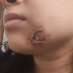 dog bite